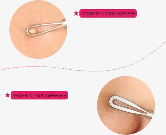 Comedone Spoon | Blackhead Remover | Acne Remover | Comedone Extractor | Blackhead Removal IRVS V1188-MS101-00215-1