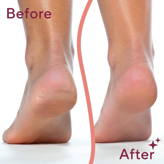 Foot Repair - Rechargeable Electric Callus Remover - Removes Dry Skin - For Smoother Feet V1188-ZXY-10328