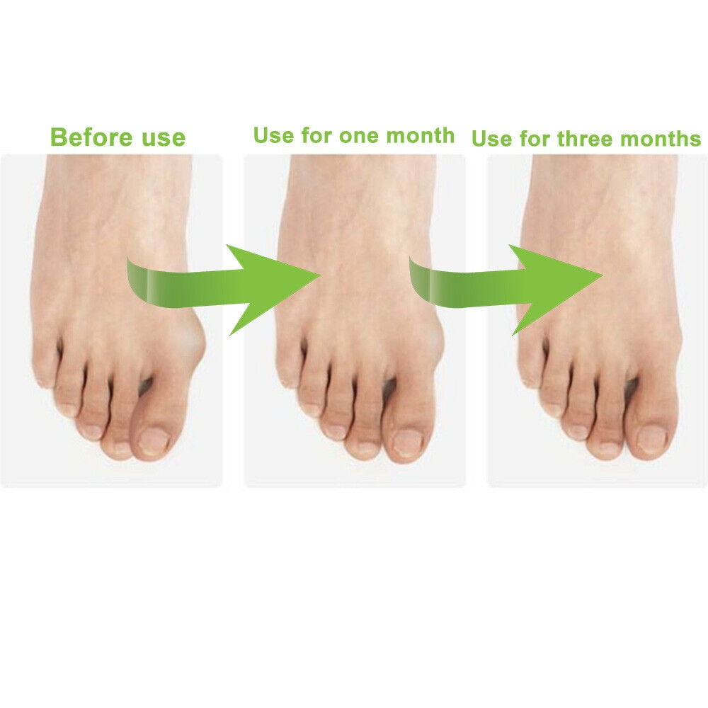 Onemayship Silicone Gel Toe Separator Orthotics Bunion Toes Spacer Pain Reliever 12Pcs V1189-LWWAL-20260325-00523