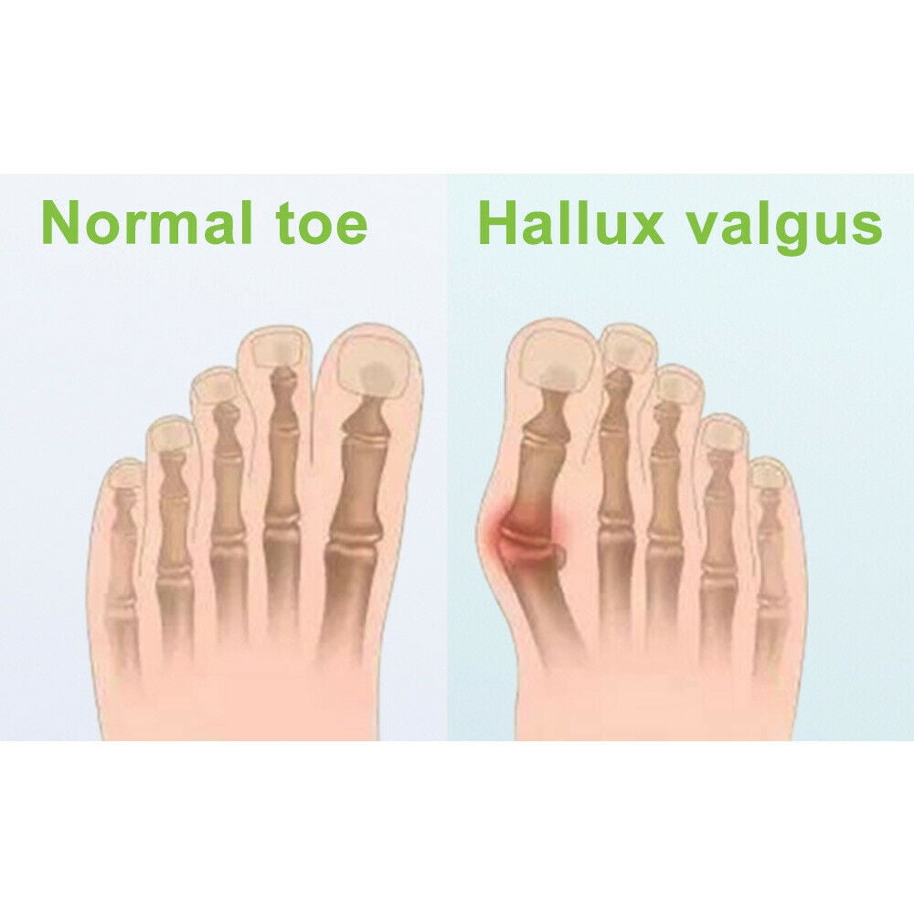 Onemayship Silicone Gel Toe Separator Orthotics Bunion Toes Spacer Pain Reliever 12Pcs V1189-LWWAL-20260325-00523
