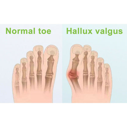 Onemayship Silicone Gel Toe Separator Orthotics Bunion Toes Spacer Pain Reliever 12Pcs V1189-LWWAL-20260325-00523