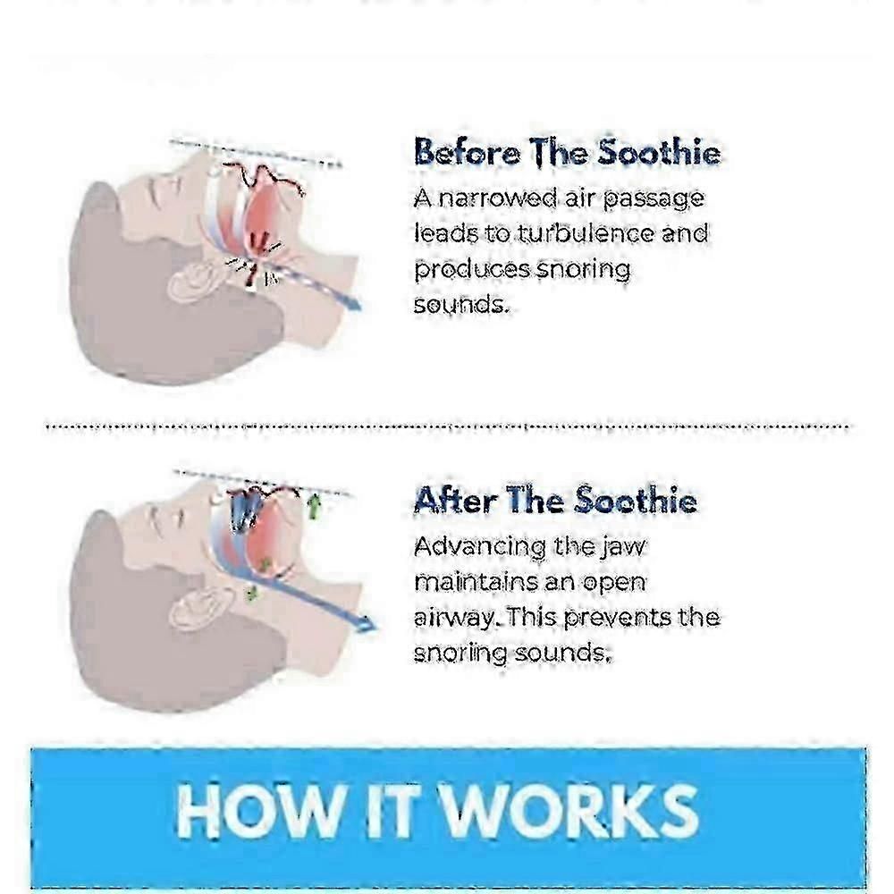 Honex Anti-Snoring Mouthpiece - Quite Night Device, Adjustable Jaw V1263-JX-6028