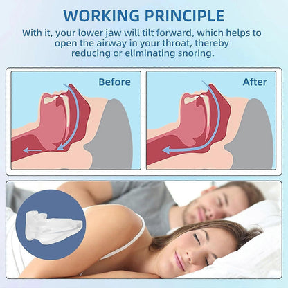 Anti-Snoring Mouthpiece - Reusable, FDA-Cleared, with Case V1263-JX-6032