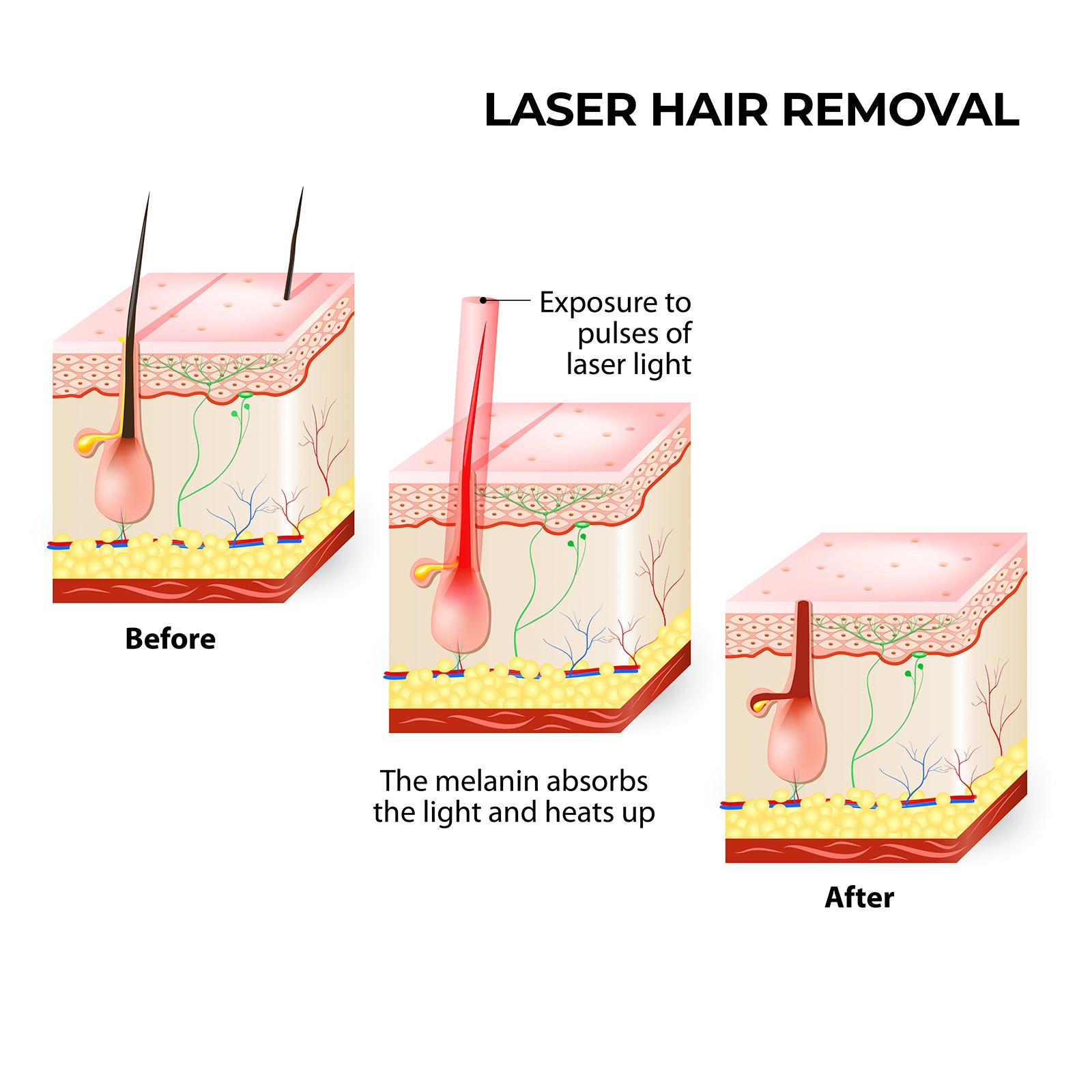 Silhouette Portable Laser Hair Remover Permanent Epliation System Body Face Home V160-351025