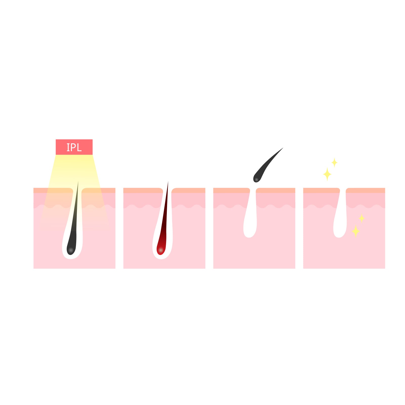 Silhouette Portable Laser Hair Remover Permanent Epliation System Body Face Home V160-351025